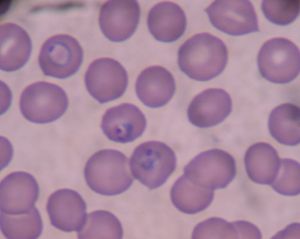 The plasmodium parasite, seen here in the ring stage taken from a blood smear, is transmitted through infected mosquitoes. Credit: Bobjgalindo/wikimedia commons
