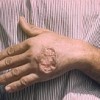 Leishmaniasis kills more than 50,000 people each year. DNDi researchers hope to develop five new - cheaper and more convenient - treatments by 2014. Credit:  D S Martin/CDC