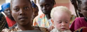 Fear, stigma and discrimination still affect whether people with albinism can safely attend school, travel freely, seek employment or earn a living. Credit: UN Photo/Marie Frechon.