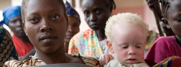 Fear, stigma and discrimination still affect whether people with albinism can safely attend school, travel freely, seek employment or earn a living. Credit: UN Photo/Marie Frechon.